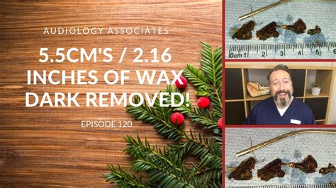 55cm216inches Of Dark Ear Wax Removed Ep 120 Youtube