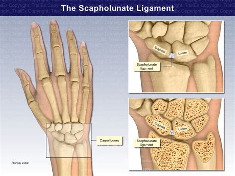 The Scapholunate Ligament Trialexhibits Inc