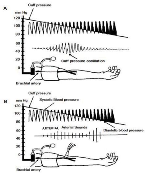 Figure 1 From Non Invasive Blood Pressure Measurement Auscultatory