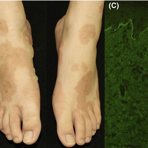 Edematous Erythema Distributed Over The Entire Body Surface With Tense