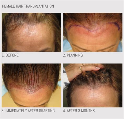 Odrzucenie Przeszczepu To Przykład Odporności - Przeszczep włosów – Zdjęcia przed i po | Przeszczep włosów Chicago