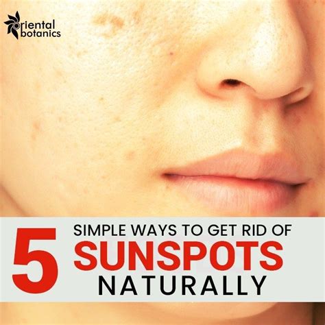 5 Simple Ways To Get Rid Of Sunspots Naturally Sun Spots On Skin Sunspots Dark Spots On Skin
