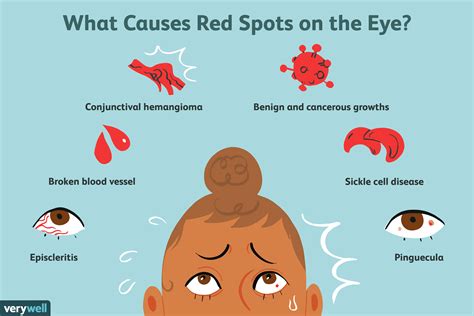 Possíveis Causas De Uma Mancha Vermelha No Olho Conselho Médico