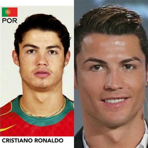 Cristiano Ronaldo Before And After Surgery