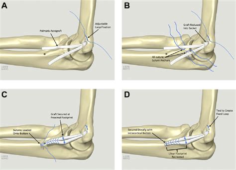 Ulnar Collateral Ligament Elbow Reconstruction