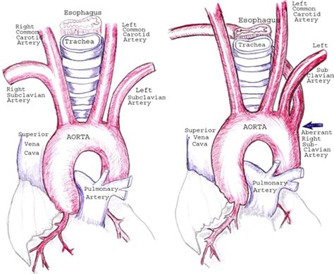 Figure From Aberrant Right Subclavian Artery Encountered During