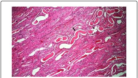 Renal Medulla Showing Collecting Tubule Distended With Hyaline Cast H