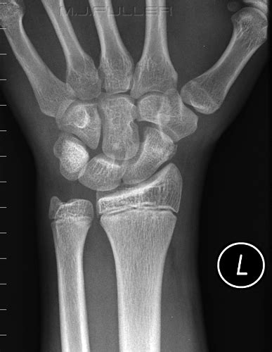 Lateral Wrist Radiograph Anatomy