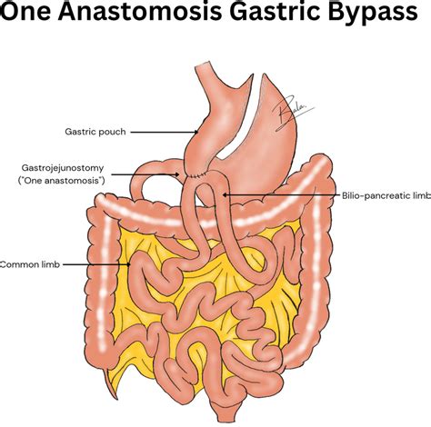 One Anastomosis Gastric Bypass Oagb The Artwork Is Done By