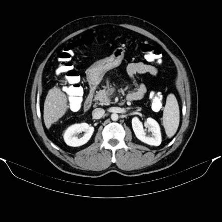 Acute Superior Mesenteric Vein Thrombosis Radiology Reference Article
