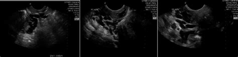 Transvaginal Ultrasound Of The Pelvic Adnexa Demonstrating My Xxx Hot