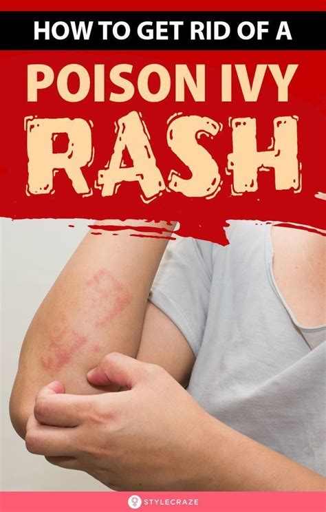 How To Get Rid Of A Poison Ivy Rash Overnight In 2021 Poison Ivy Rash How To Get Rid Poison