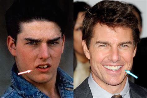 Tom Cruise Plastic Surgery Before And After I Havent And I Never Would