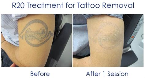 Capitano Cento Anni Partecipare Tattoo Laser Treatment Cronico Registrazione Risolvere