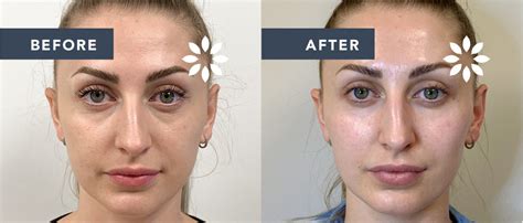 Cheek Filler Before And After 895372 8 West Clinic Vancouver
