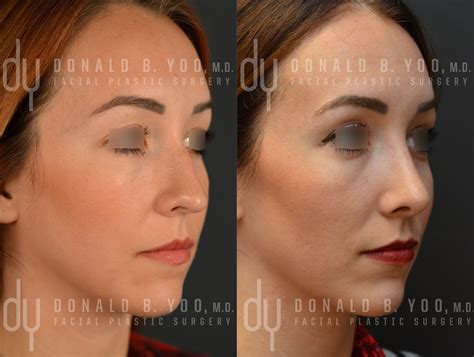Before And After Primary Open Rhinoplasty And Septoplasty With Dorsal
