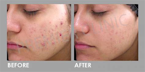 Premier Chemical Peel Peel Away Your Skin Imperfections Premier Clinic