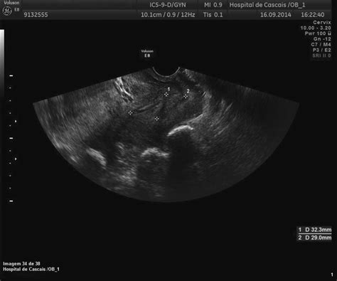 pelvic ultrasound two separate cervices left anterior 32 3 mm and download scientific