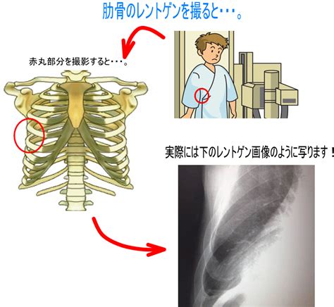 肋骨骨折（肋骨骨折って、レントゲンに写らないの？） | 古東 ...