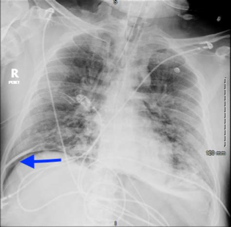 Cureus An Intriguing Case Of Pneumoperitoneum In A Patient With Covid