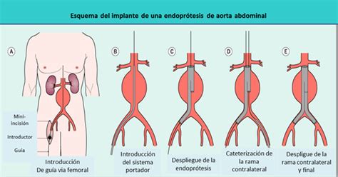 Aneurisma Aorta Abdominal Anatomía Wikisabio
