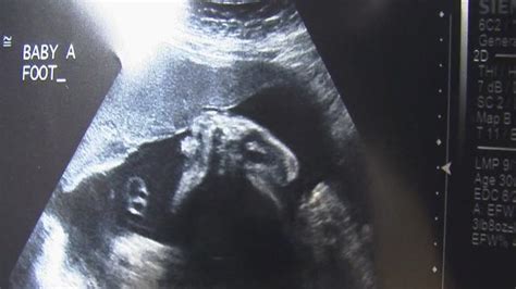 rare mono mono newborn twins doing well in ohio yahoo news