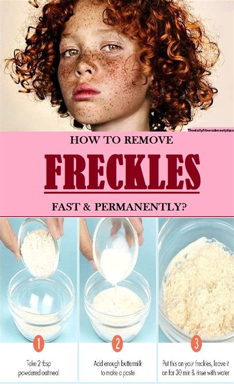 How To Remove Freckles Fast And Permanently At Home In 2020 Freckle