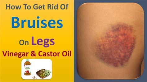 How To Get Rid Of Bruises On Legs Vinegar And Castor Oil Youtube