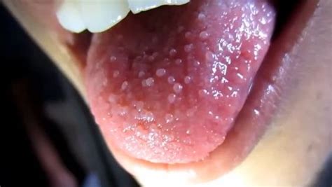 Causes Bumps Back Tongue Khảm Gà Đậu