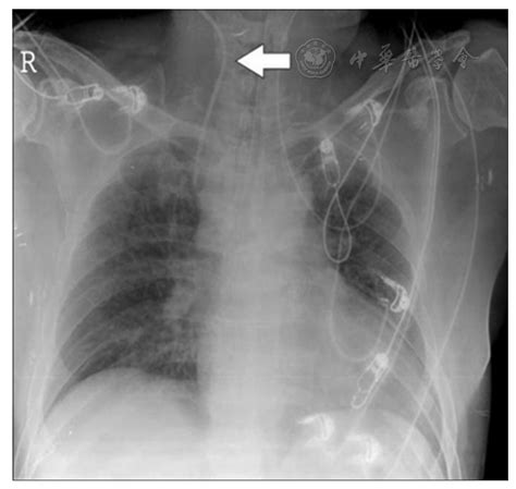 Malposition Of Central Venous Catheter Presentation And Management