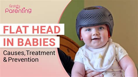 Flat Head In Babies Plagiocephaly Should Be Worried Youtube