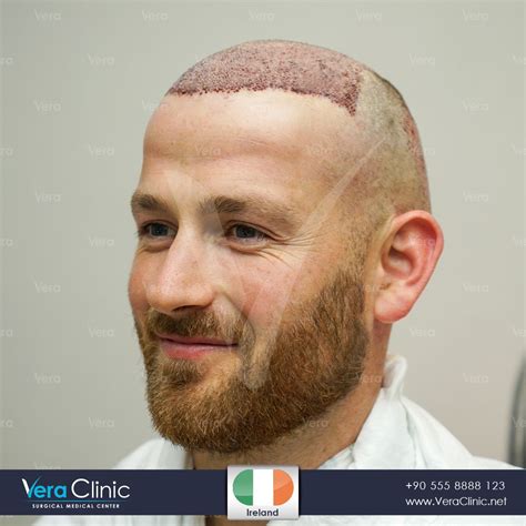 Body Contouring Surgery Facial Contouring Treat Alopecia Prp Hair