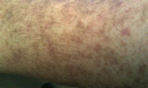 I Have Purple Spots On My Lower Legs That I Have Been Told Is