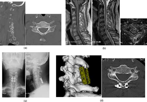 Figure 2 From Spinous Process Plate Fixation For Cervical Spinal Fusion