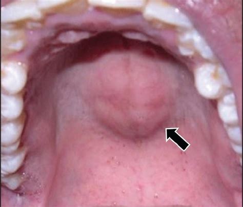 Roof Of Mouth Palate