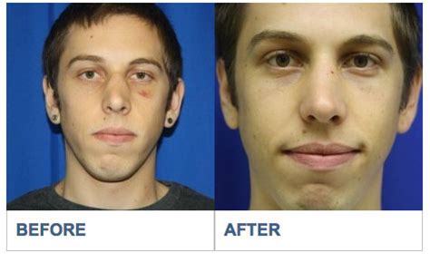 Symptoms due to the deviated septum — particularly nasal obstruction — often completely resolve. Deviated Septum Repair Surgery in Los Angeles,California ...