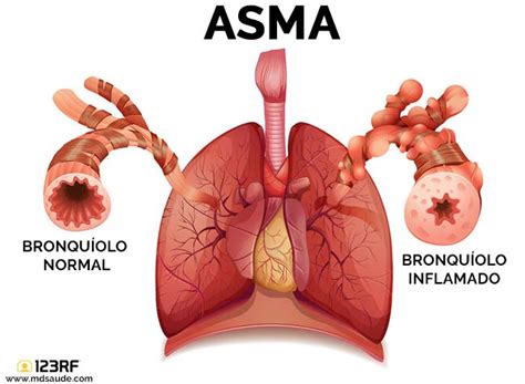 Asma Bronquial Qu Es S Ntomas Y Tratamiento Md Sa De