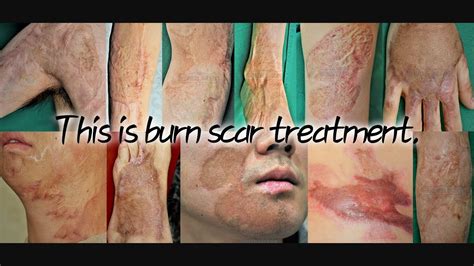 Are You Worried About Burn Scars I Will Treat Everything Youtube