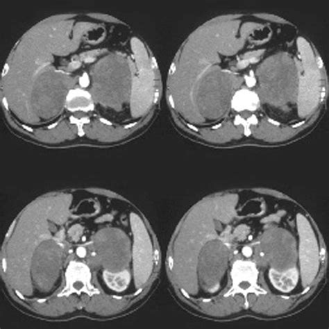 Non Hodgkins Lymphoma Of The Testicle And Bilateral Adrenals Detected