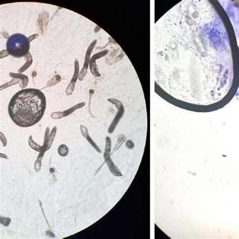 Standard Skin Surface Biopsy Revealed Multiple Demodex Mites On The