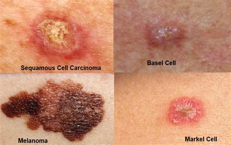 Skin Cancer Types Most Common Skin Cancer Sunskinclinic