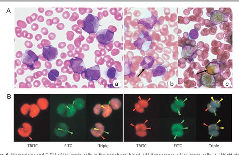 Figure 1 From Microgranular Variant Acute Promyelocytic Leukemia