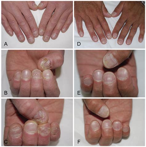Psoriasis Of The Fingernails Treatment Share News About Nail