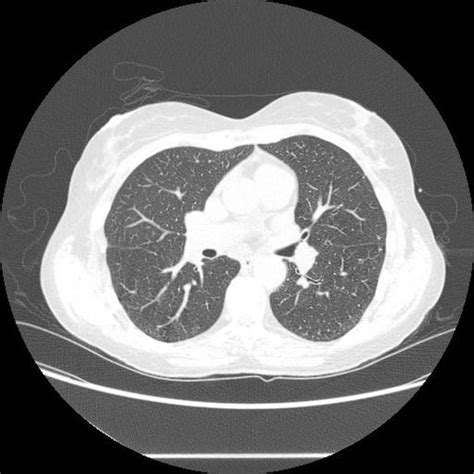 Learn about pleural effusion (fluid in the lung) symptoms like shortness of breath and chest pain. Loculated pleural effusion | Radiology Case | Radiopaedia.org