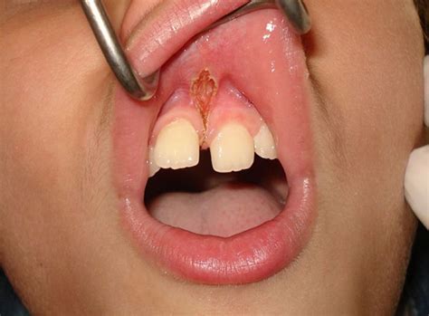 Upper Lip Laser Frenectomy Without Infiltrated Anaesthesia In A