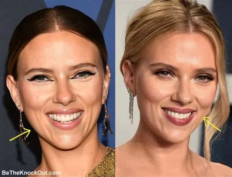 Scarlett Johansson Plastic Surgery Comparison Photos