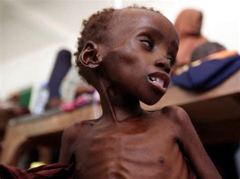 Malnutrição Mata 31 Milhões De Crianças Por Ano Tvi24