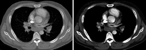 Chest Ct Shows Bilateral Hilar And Mediastinal Lymphadenopathy And Wide