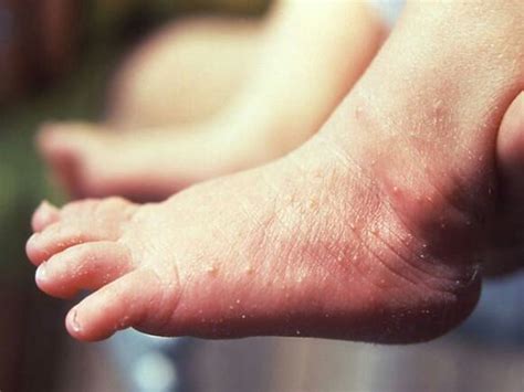 Tiny Red Bumps On Hands And Feet October 2014 Babycenter Canada