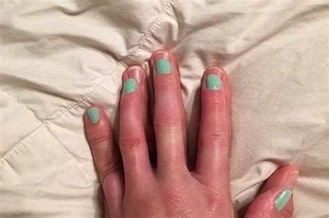This Husband Has A Simple Way To Support His Wife After She Lost Her Pinky Support Wife Pinky